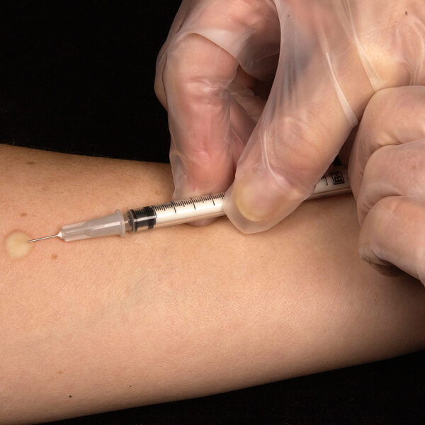 2004
Gabrielle Benenson

This technician is in the process of correctly placing a Mantoux tuberculin skin test in this recipients forearm, which will cause a 6mm to10mm wheal, i.e., a raised area of skin surface, to form at the injection site.The Mantoux tuberculin skin test is used to evaluate people for latent tuberculosis (TB) infection. In the United States, this skin test consists of an intradermal injection of exactly one tenth of a milliliter (mL) of tuberculin, which contains 5 tuberculin units. Correct placement of this intradermal injection involves inserting the needle bevel slowly at a 5° to 15° angle. The needle bevel is advanced through the epidermis, the superficial layer of skin, approximately 3mm so that the entire bevel is covered and lies just under the skin. A tense, pale wheal that is 6 to 10mm in diameter appears over the needle bevel.